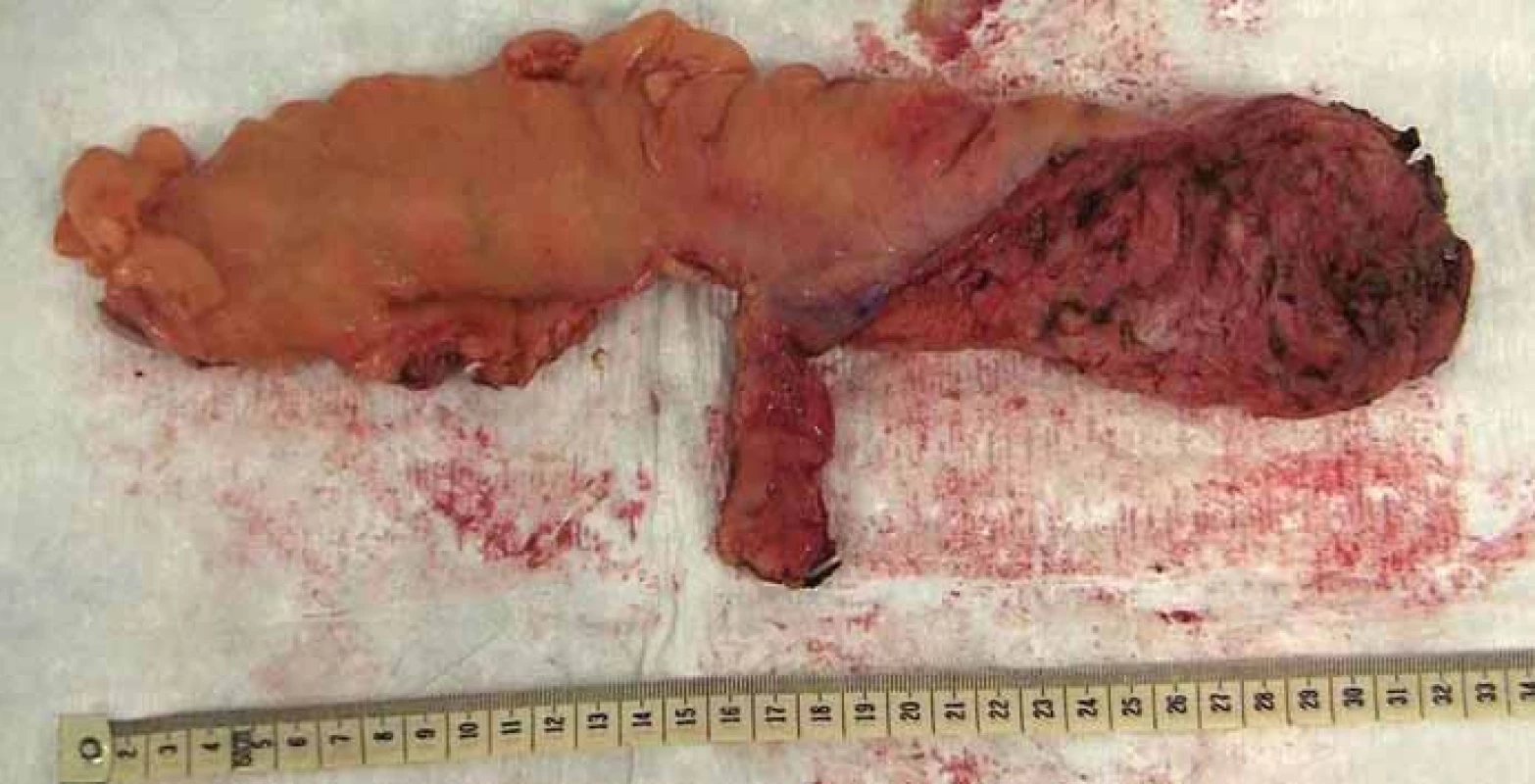 Resekát rekta s totální mezorektální excizí.
Fig. 6. Rectal specimen with total mesorectal excision.