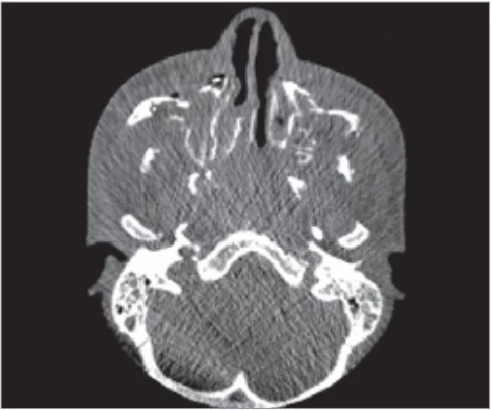 Condyle position in axial plane.