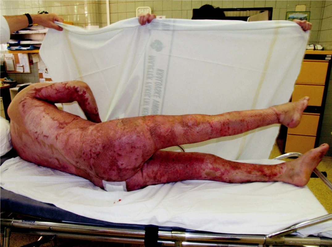 Status at outpatient check-up in April 2007