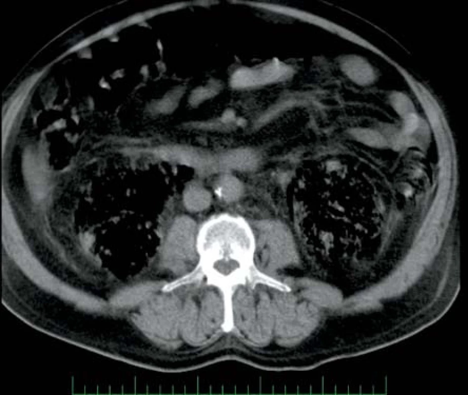 Rozsáhlé oboustranné postižení ledvin
Fig. 1. Extensive bilateral affection of kidneys
