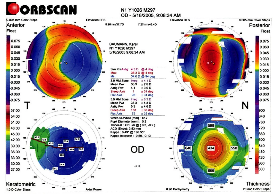 Topografický nález po LASIK (VOD: 5/7,5, s-2,0 ax 80…5/7,5 lépe, dkn).