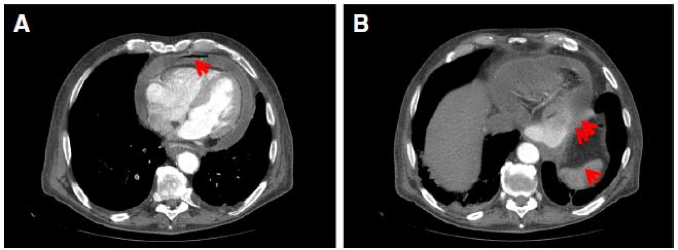Computed tomogram showing a pneumopericardium (arrow) and pericardial effusion, and b mass within a hiatus hernia (single arrow) and likely area of fistulation (double arrow