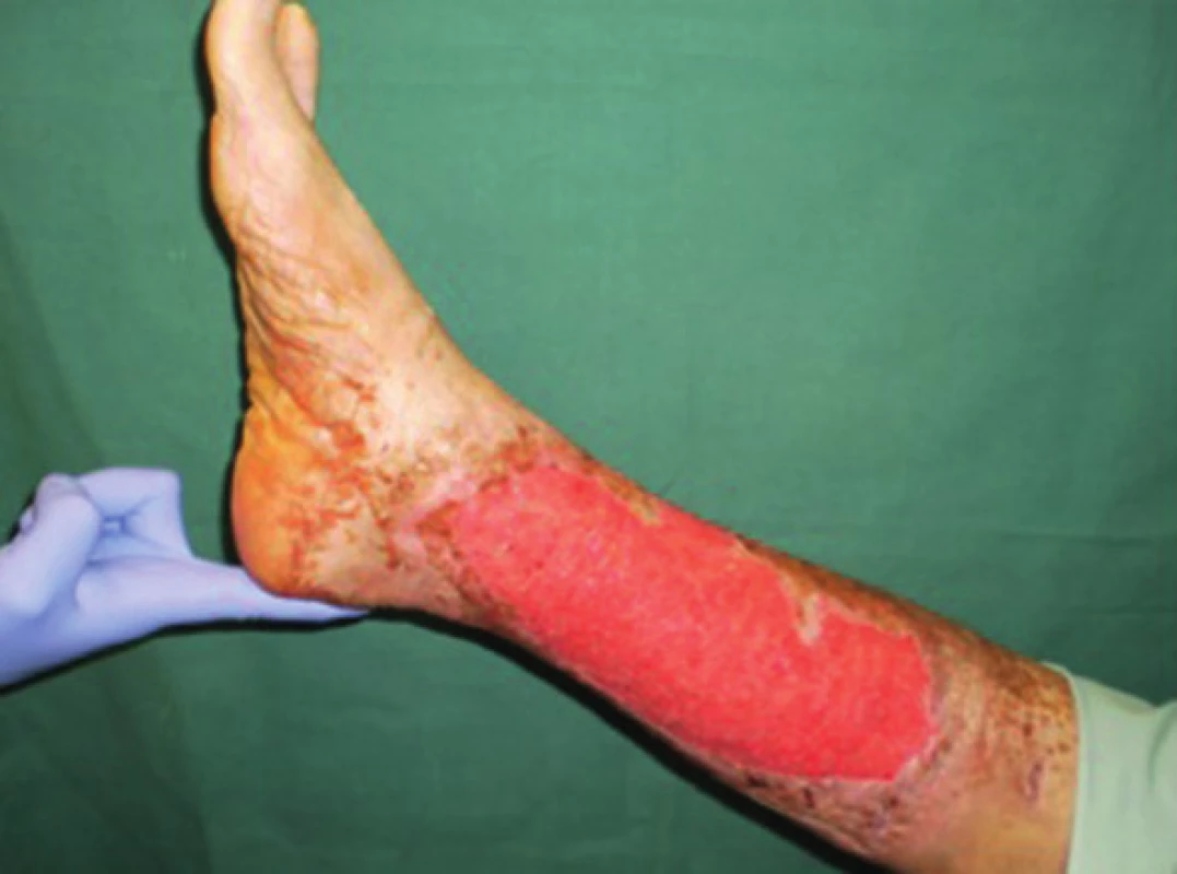 Pacient č. 3 − chronický kožní defekt po débridement a VAC péči trvající 6 dnů
Fig. 1: Patient No. 3 − chronic wound after debridement and 6 days of VAC therapy