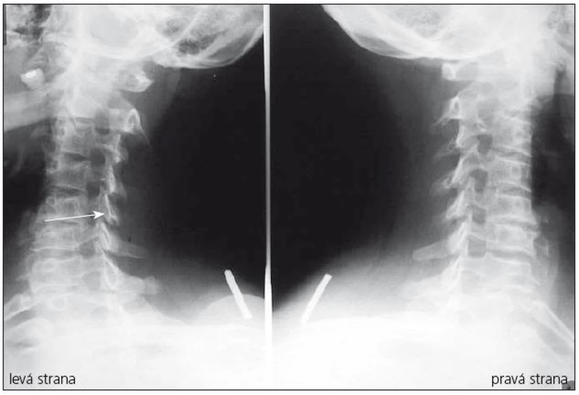 Šikmé snímky krční páteře, výrazné spondylózní omezení neuroforamina C5–6 vlevo.