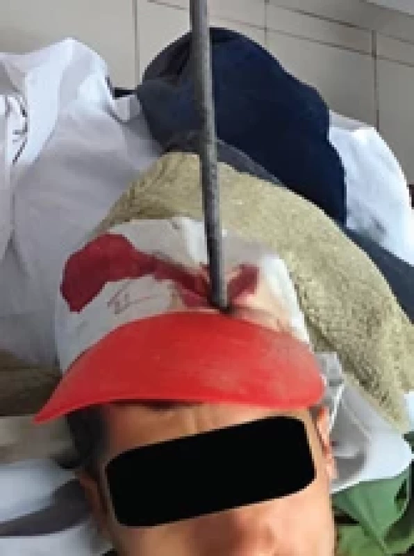 Condition of the patient when he was fi rst examined in the emergency room. </br>Obr. 1. Stav pacienta při prvním vyšetření v ambulanci urgentního příjmu.