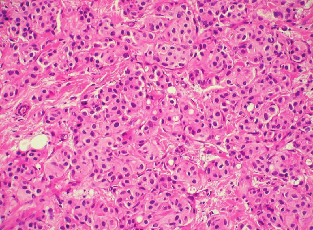 Dominantní histologickou strukturou byl ve všech případech běžný invazivní duktální karcinom, který nepoutal bližší pozornost (HE, 200x)