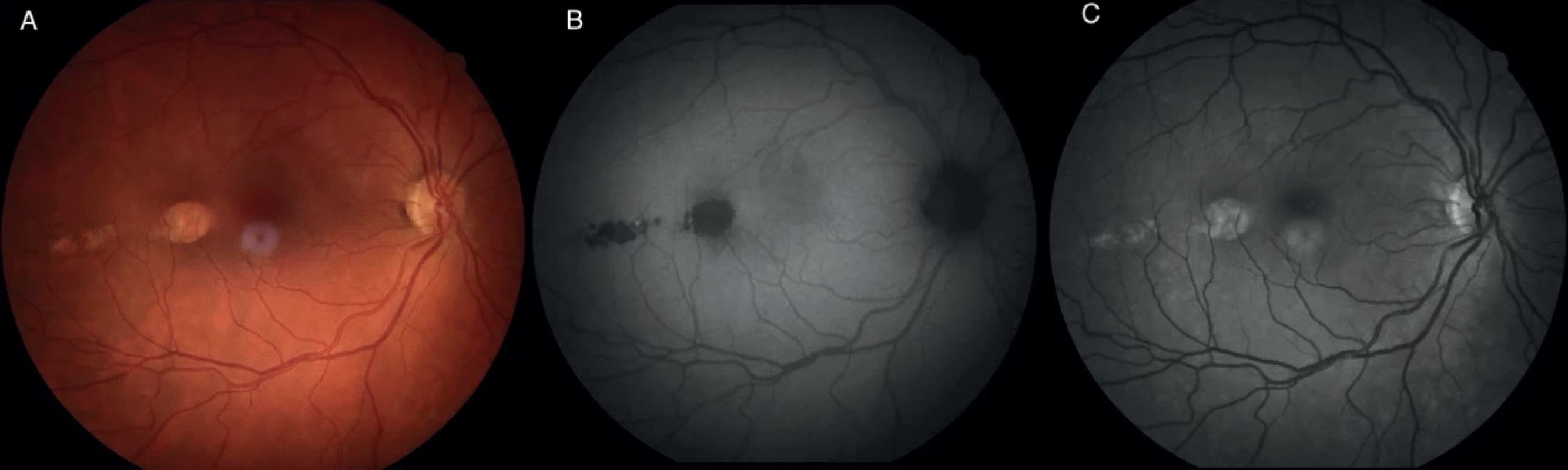 Fundus photo (A) of the right eye with torpedo maculopathy, fundusautofluorescence (B) shows areas of hypofluorescence in the place of the main and satellite lesions, the red free image (C) highlighted the lesion