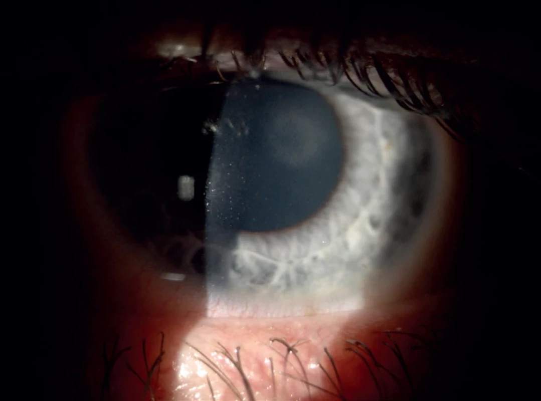 Image of the anterior segment of the left eye in the case report patient at hospital discharge. Reduced transparency and corneal edema are improved; semipigmented deposits are present on the endothelium
