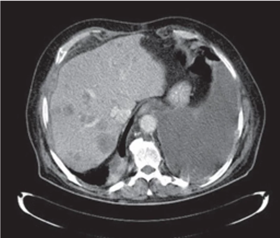 Axiální CT scan – mnohočetný metastatický proces v jaterním parenchymu obou jaterních laloků. Fig. 1. Axial CT scan – multiple metastatic process in the liver parenchyma of both liver lobes.