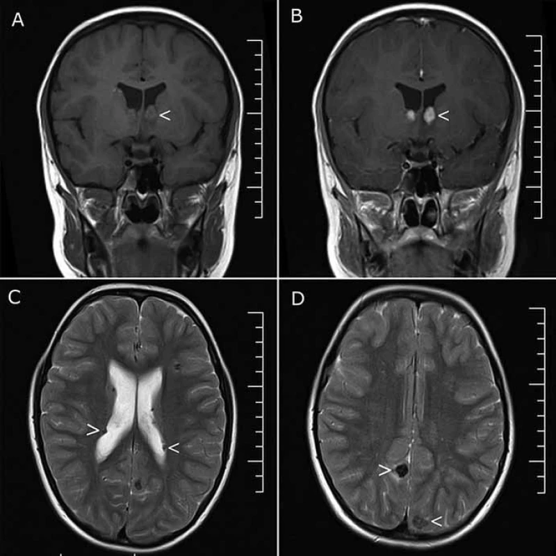 MR vyšetření u pacienta 1.
Obr. 1a) Sekvence T1 v koronární rovině – obrovsko-buněčné astrocytomy (SEGA)
oboustranně v oblasti foramen Monroi (šipka).
Obr. 1b) Sekvence T1 v koronární rovině – obrovsko-buněčné astrocytomy (SEGA)
oboustranně v oblasti foramen Monroi (šipka) s homogenním sycením po aplikaci kontrastní
látky.
Obr. 1c) Sekvence T2 v axiální rovině – vícečetné subependymální noduly (šipka).
Obr. 1d) Sekvence T2 v axiální rovině – hypointenzní ložiska kortikálně okcipitálně
oboustranně charakteru tuberů s kalcifikací (šipka).