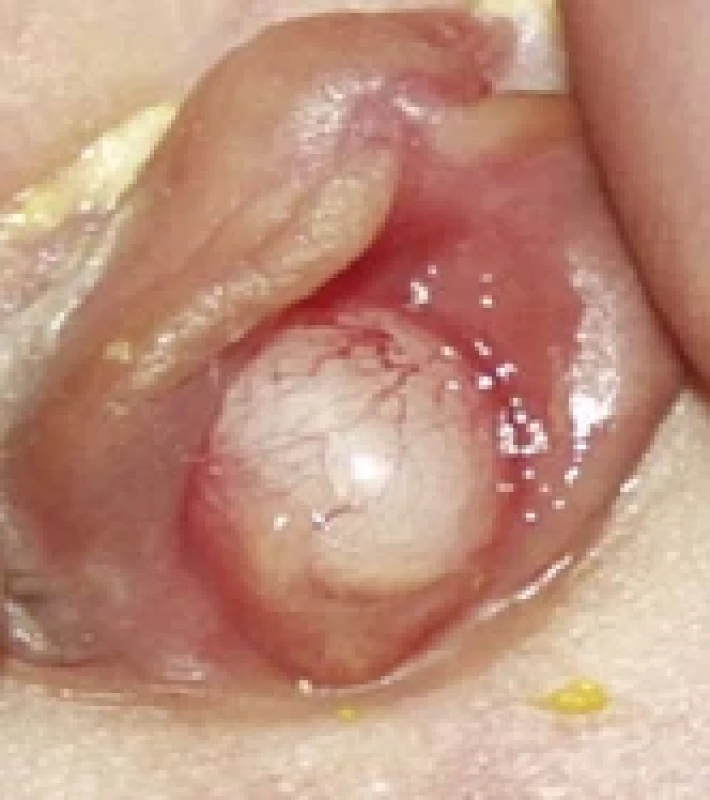Imperforate hymen with hydrocolpos. Obr. 2. Neperforovaná panenská blána s hydrokolposem.