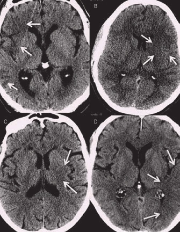 Časné známky ischemie na nativním CT. A – hypodenzita v pravé inzule a periferii ACM (M1 a M3 dle ASPECTS), B – hypodenzita v oblasti ncl. caudatus, lentiformis a přední části inzuly, C – hypodenzita v ncl. lentiformis, D – setření kortikomedulárního rozhraní v zadní části inzuly a úseku M 2,3 dle ASPECTS.