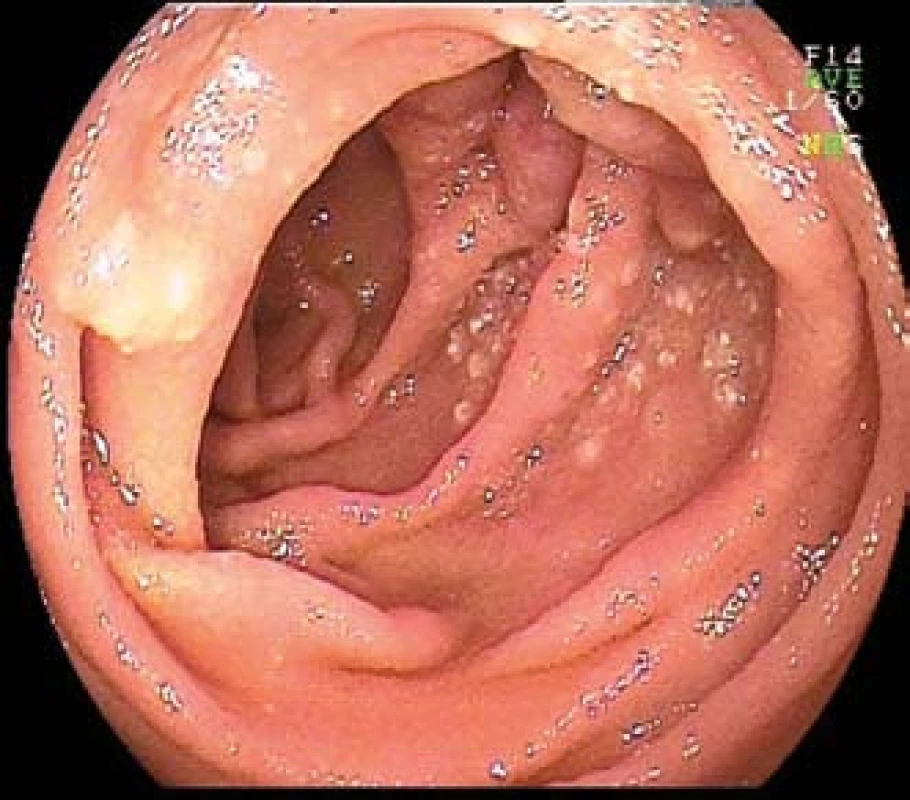 MALT lymfom jejuna u 70leté pacientky s mikrocytární anemií. Dvojbalonová enteroskopie.
Fig. 4. MALT lymphoma of the jejunum in 70-year-old patient with microcytic anemia. Double-balloon enteroscopy.