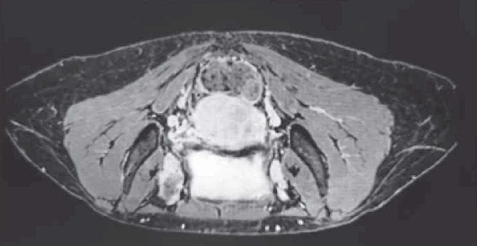 T2-weighted magnetic resonance imaging in the axial view, after administration of gadolinium-based MDC, demonstrating marked enhancement of the lesion.
// T2-vážený obraz magnetické rezonance v axiálním pohledu, po podání minimální detekovatelné dávky kontrastní látky s gadoliniem, který svědčí o zřetelném zvětšení léze.
