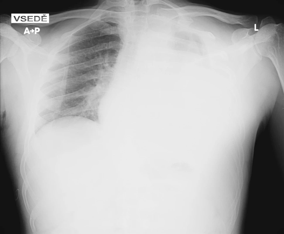 Snímek hrudníku při přijetí, na kterém je patrné zastření téměř celého levého hemitoraxu 
Fig. 1 Admission chest x-ray, with opacity covering nearly all of the left hemithorax