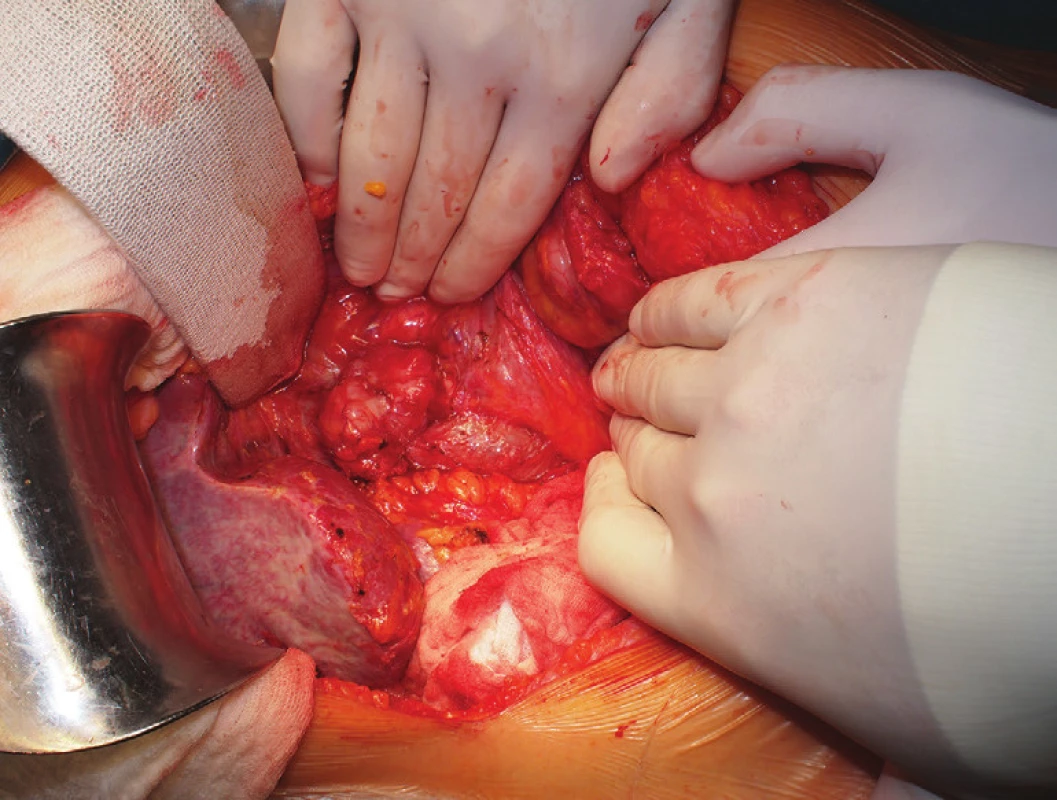 Tumor mezi duodenem a v. cava inf.
Fig. 4: Tumor between the duodenum and inferior caval vein