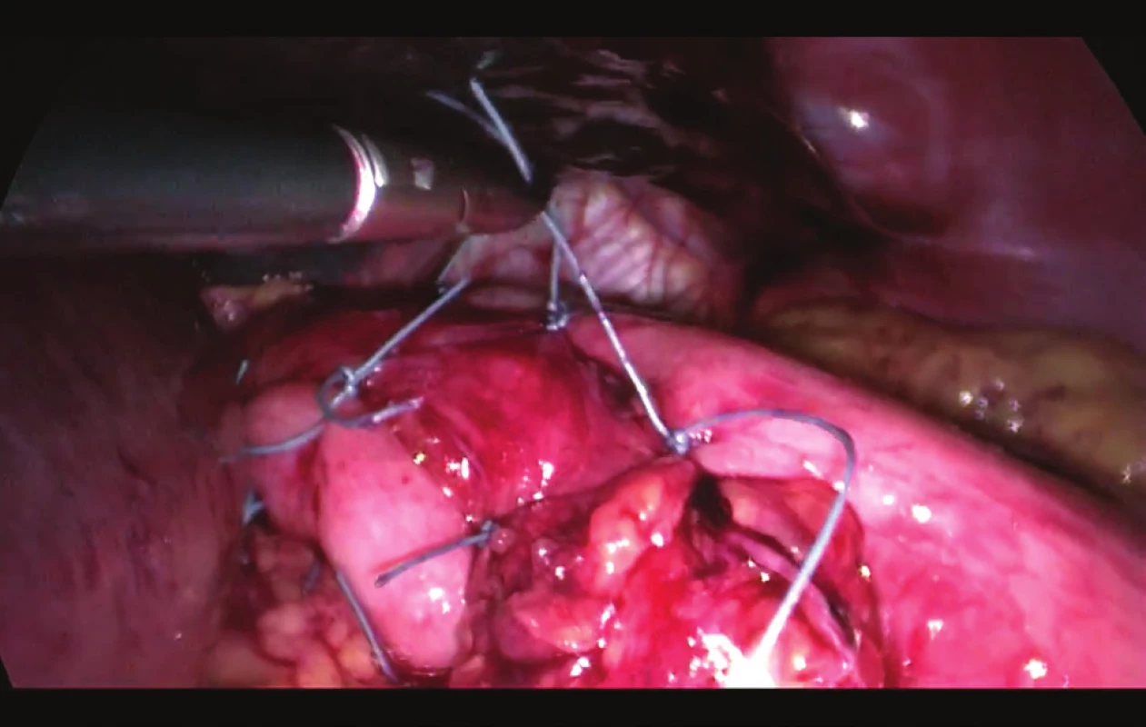 Fundoplikace dle Toupeta
Fig. 4: Fundoplication according to Toupet