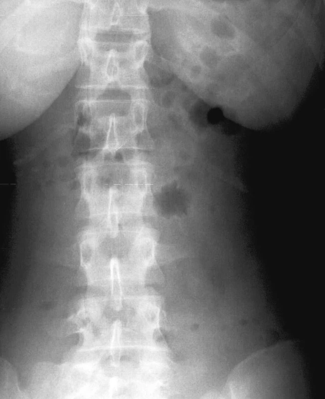 Natívna snímka brucha v antero-posteriórnej projekcii
Fig. 1. Native abdominal view in A-P projection
