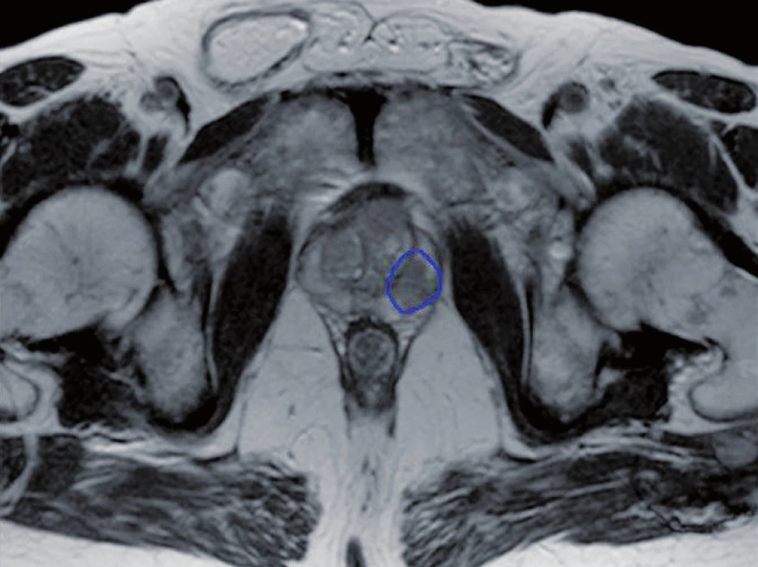 Zakreslení intraprostatické léze
Fig. 1. Contour of intraprostatic lesion