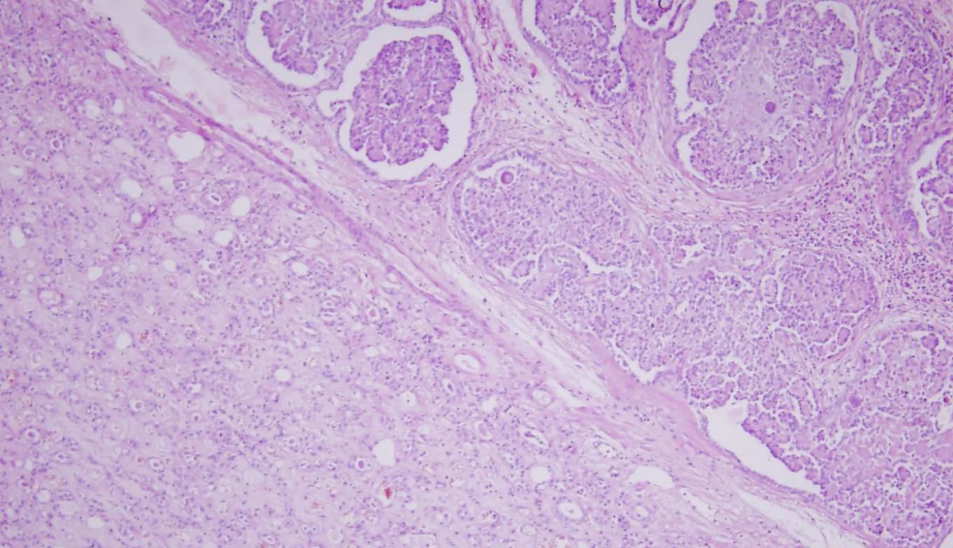 Histologické vyšetření preparátu tumoru ledviny: karcinosarkom v levé části obrázku, v pravém horním rohu parenchym ledviny s glomeruly, zvětšení 100x
Fig. 3. Histological specimen of kidney tumor – carcinosarcoma on the left part of the picture, on the right part renal parenchyma with glomeruli, ZOOM 100x