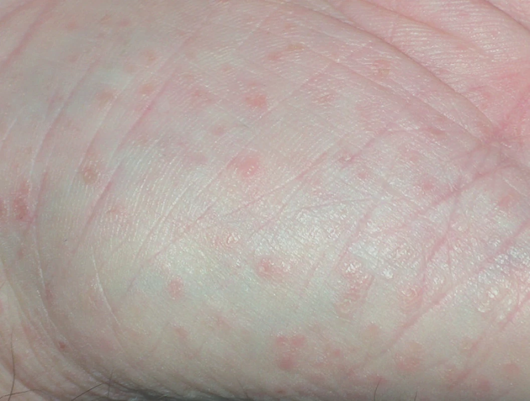 Morbus Darier – palmární keratodermie, místy dolíčkování.