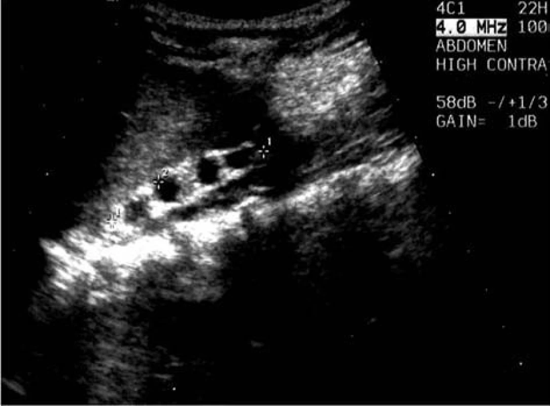 Zmenšení nálezu u stejného pacienta ve věku 4 let.
Fig. 4. Reduced finding in the same patient at the age of 4 years.