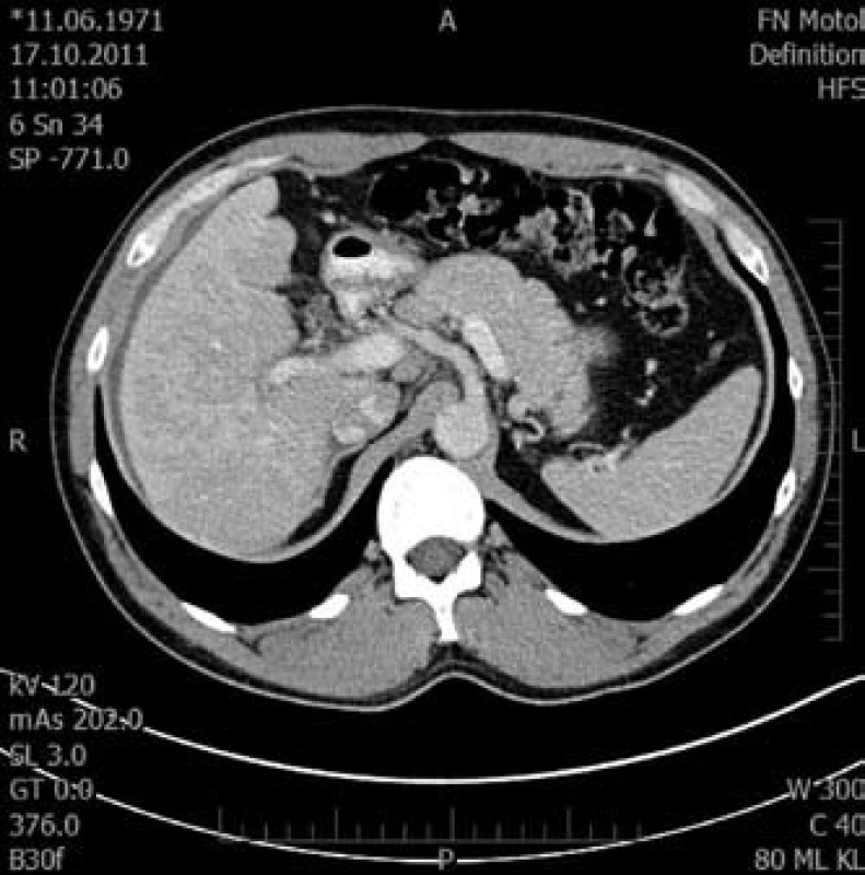 Tranzverzální řez pravého laloku jaterního ve venozní fázi.
Fig. 5. Transversal cut of right liver lobe in venous phase.