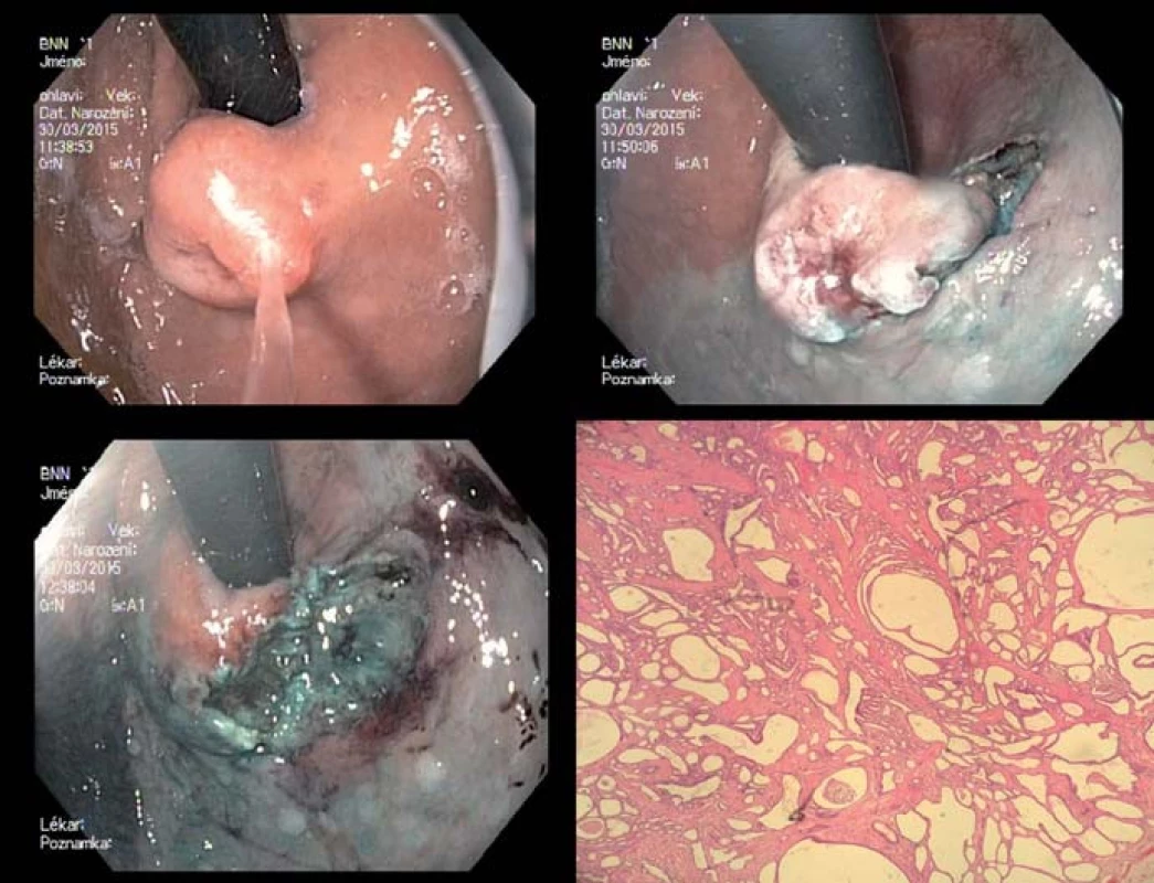 ESD submukózního hamartomu kardie v IKEM (nádor vycházel ze submukózy s intaktní m. propria).
Fig. 13. ESD of submucosal hamartoma of cardia at the ICEM (the tumour originated from the submucosa of intact m. propria).