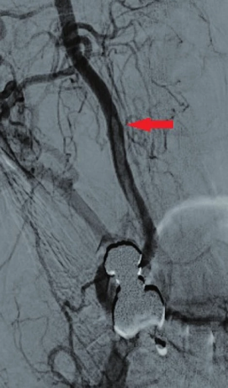 Angiografické zobrazení stenozy a volně vlajícího trombu
Fig. 5: Angiography presenting the stenosis and the free-floating thrombus