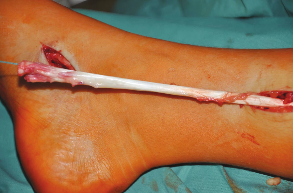 Vypreparovaná šlacha m. tibialis posterior protažena do incize na mediální straně bérce
Fig. 1: The dissected posterior tibial tendon inserted into the incision on the medial side of the shank