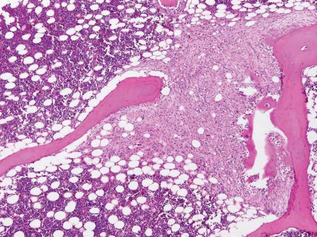 Metastáza anaplastického astrocytomu v kostní dřeni bederního obratle (barvení hematoxylin-eozin).