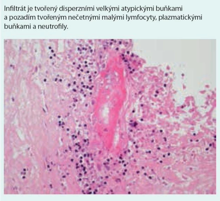 Pleomorfní infiltrace s patrným angiocentrizmem a angiodestrukcí