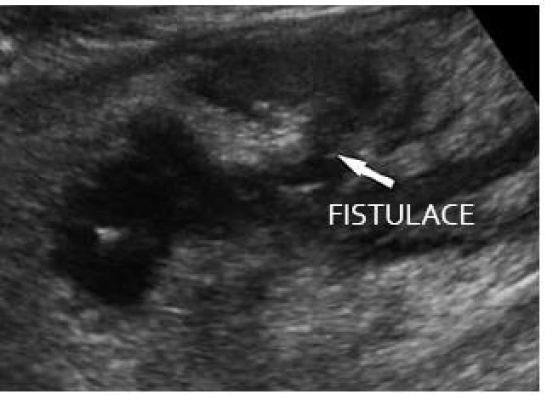 M. Crohn – postižení tlustého střeva v oblasti lienální flexury s aktivitou, fistulacemi a zánětlivým pseudotumorem v okolí.
Fig. 10. M. Crohn – large intestine involvement in the lienal flexure with activity, fistulation and inflammatory pseudotumour in the surroundings.