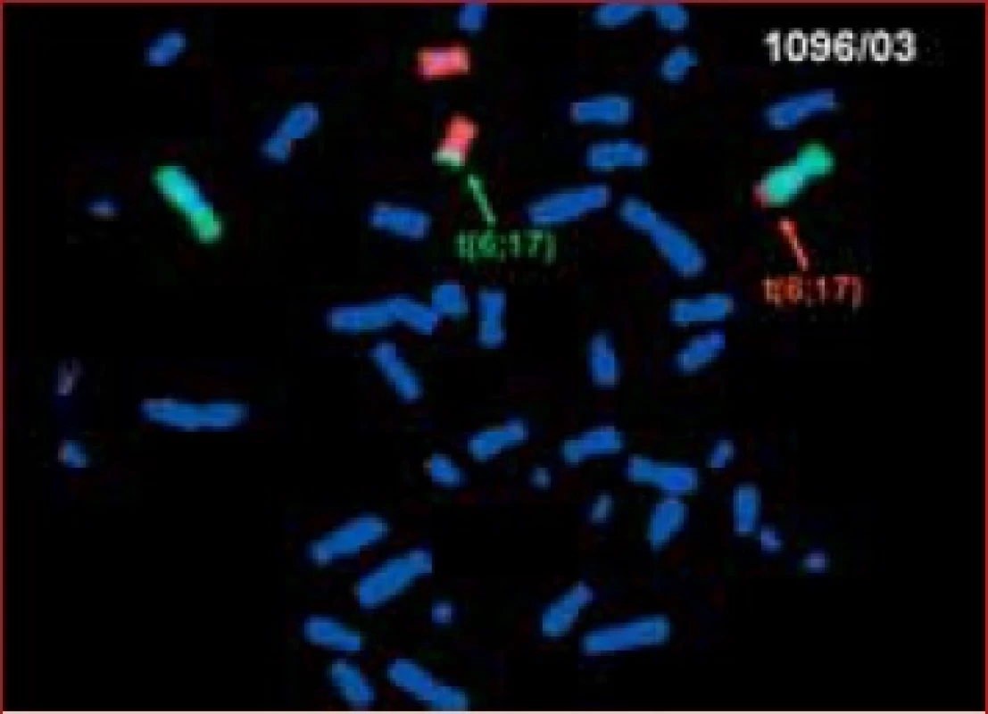 Karyotyp pacienta s anamnézou 2 spontánních potratů u partnerky, 46,XY, t (6;17). Metoda FISH (StarFISH WPC 6,17 DNA Probe).