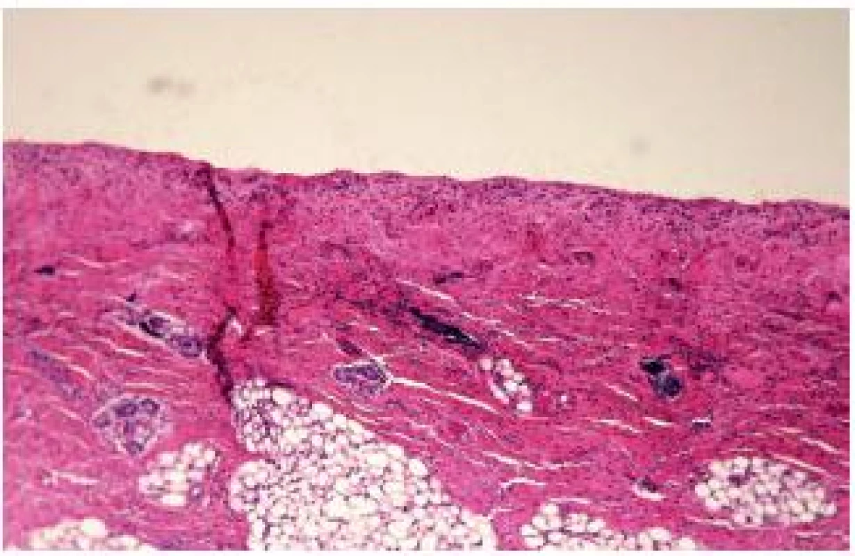 Absencia epidermy v oblasti CLAS (HE, 12x).