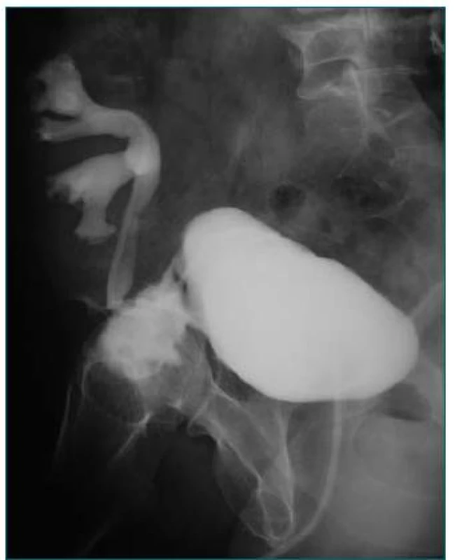 Urinózna fistula podmienená nezahojenou suturou cystotómie u pacienta po transplantácii obličky.