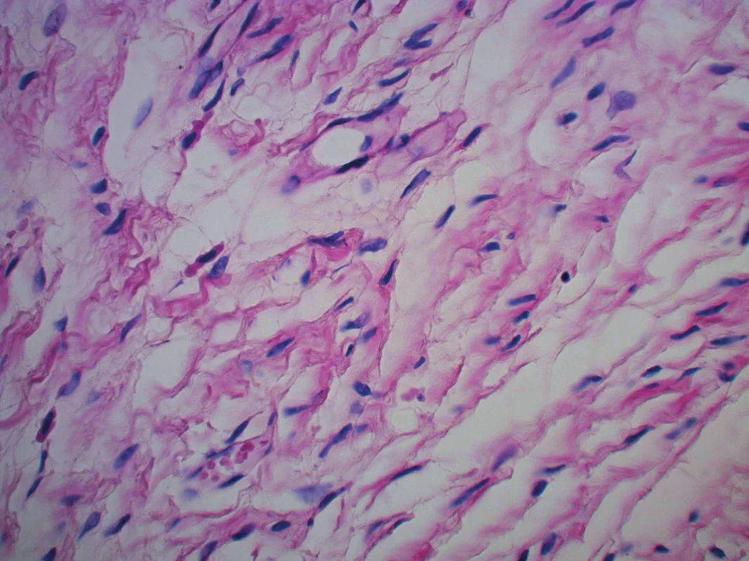 Detailní foto neurofibromu (HE, zvětšení 40krát)