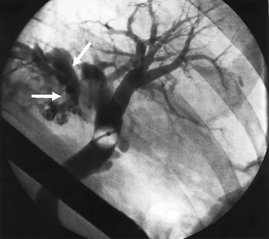 Endoskopická cholangiografic.
Fig. 4. Endoskopic cholangiography.
Šipkami označené mnohočetné defekty v náplni levého jaterního žlučovodů a jeho větví
Arrows indicate multiple defects in the left hepatic duct and its branches fillings