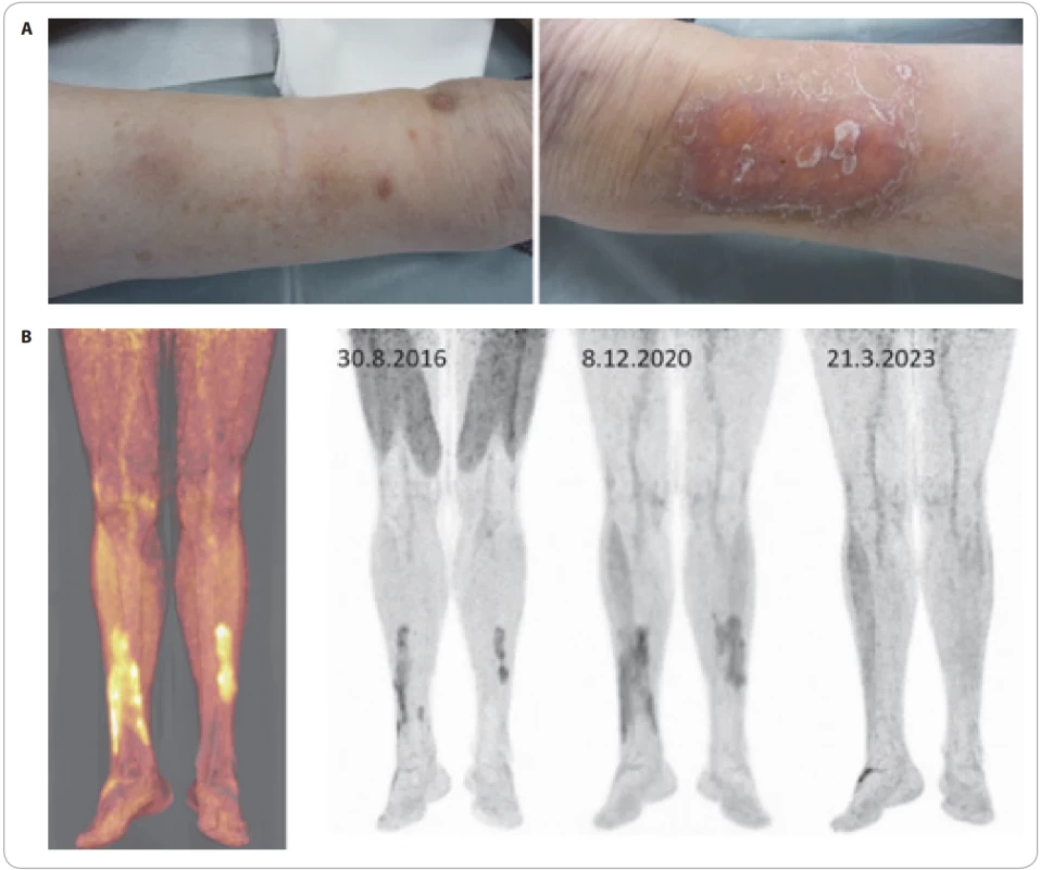 Nekrobiotický xantogranulom. (A) Ložiska v podkoží pacienta s mnohočetným myelomem. Někdy může prosvítat žlutavé zabarvení, jak je vidět vpravo. (B) Zobrazení nekrobiotického xantogranulomu, barevný obraz vlevo ukazuje stav před léčbou, obraz vpravo pak vývoj u pacienta léčeného daratumumabem, revlimidem a dexametazonem a imunomodulačními dávkami nitrožilních imunoglobulinů. Redukce akumulace při léčbě signalizuje léčebnou odpověď. 