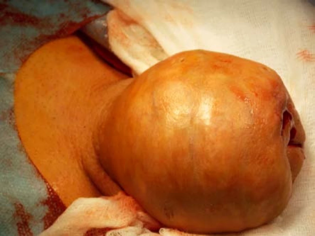 Předoperační nález objemného podkoží penisu
Fig. 3. Preoperative finding of the bulky subcutaneous penile tissue