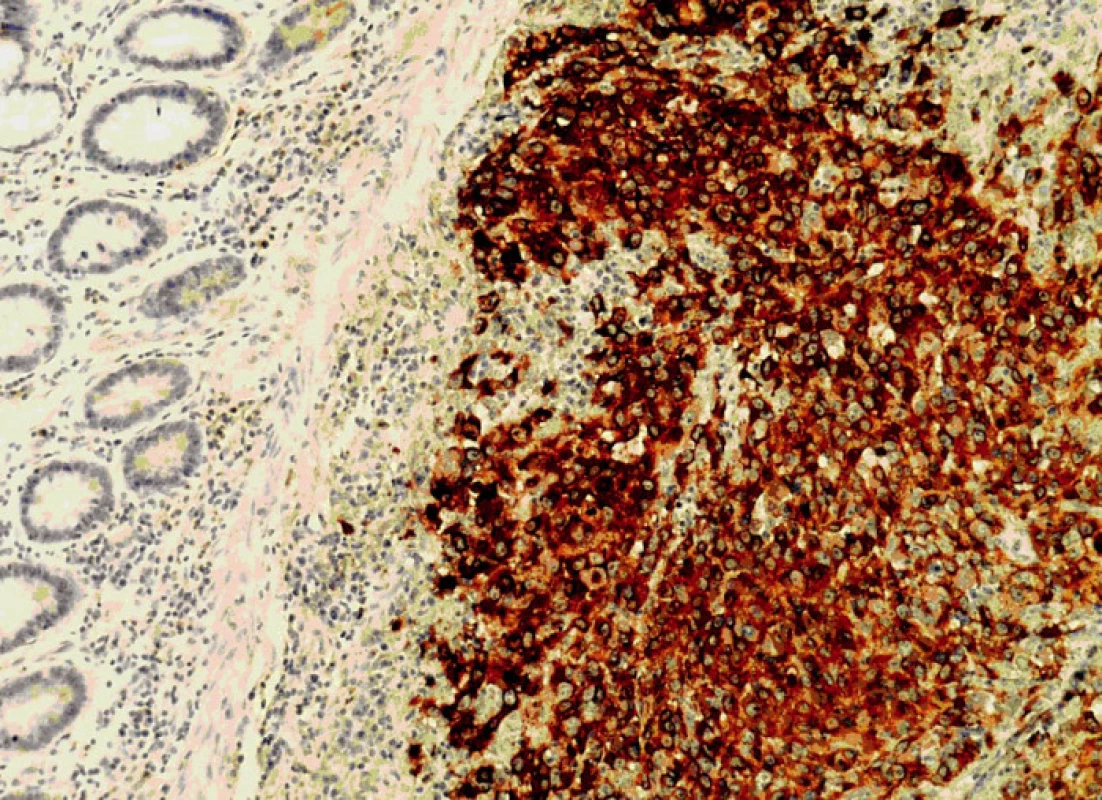 Exprese HMB 45 nádorovými buňkami (100x)
Fig.7. The expression HMB 45 of the tumor cells (100x)