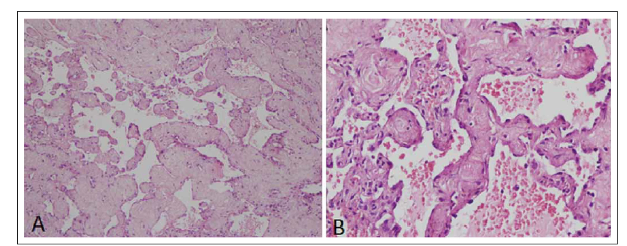 H &amp; E × 100 section showing irregular varying size vascular channel lined by endothelial cells and separated by thick collagenized tissue (A). H &amp; E × 400 showing blood cells filled with collagenized intervascular spaces (B).