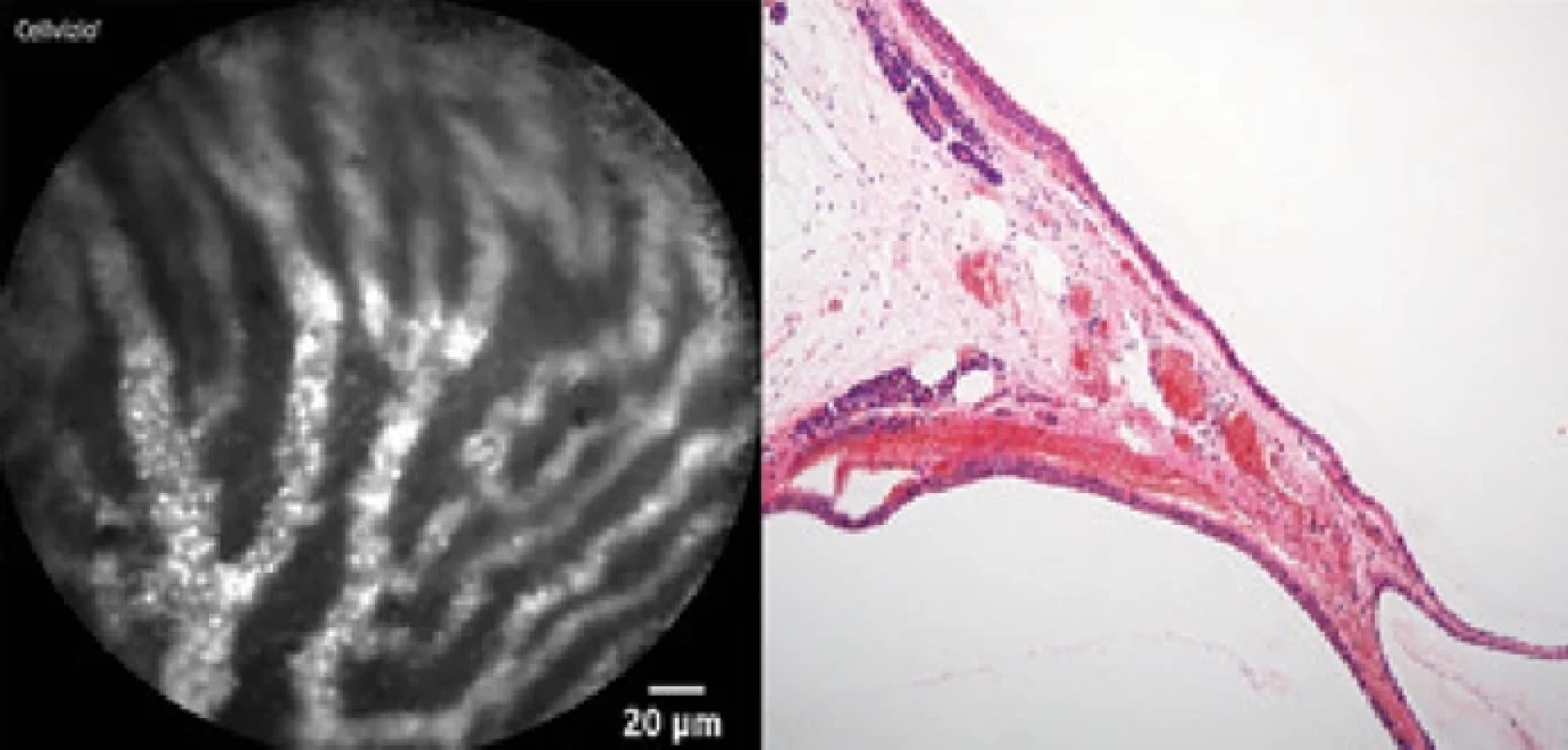Serózní cystadenom – v nCLE obraze (vlevo) typická podslizniční vaskulární síť (světlé vinuté cévy s patrnými erytrocyty), v histologickém obraze (vpravo) odpovídající cévní struktury v septu mezi cystami.