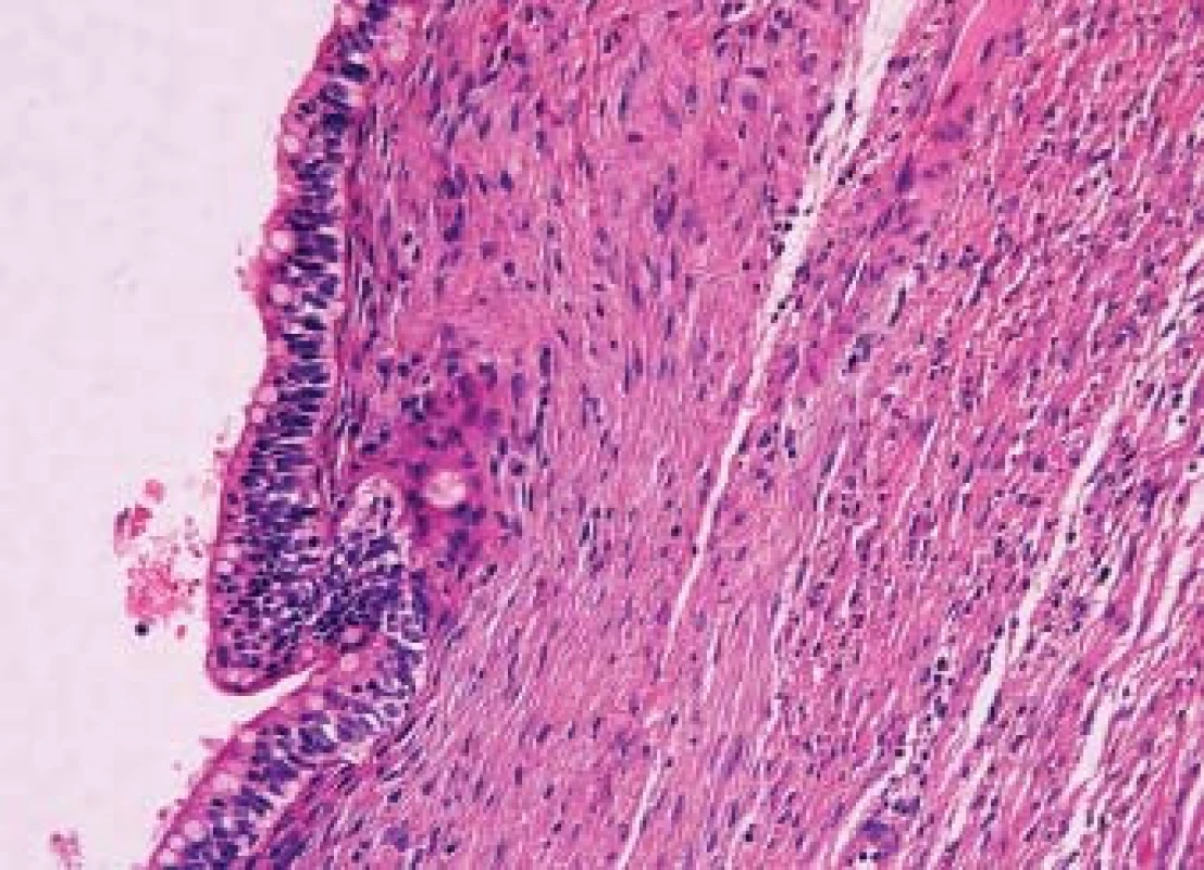 Dobře diferencovaná teratomová komponenta smíšeného germinálního tumoru. Zejména smíšené germinální nádory varlete dokáží zakládat morfologicky velmi variabilní metastázy. HE 100x.