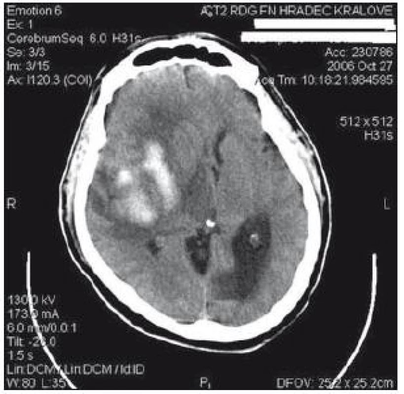 CT s nálezem spontánního intracerebrálního krvácení u pacienta 3.