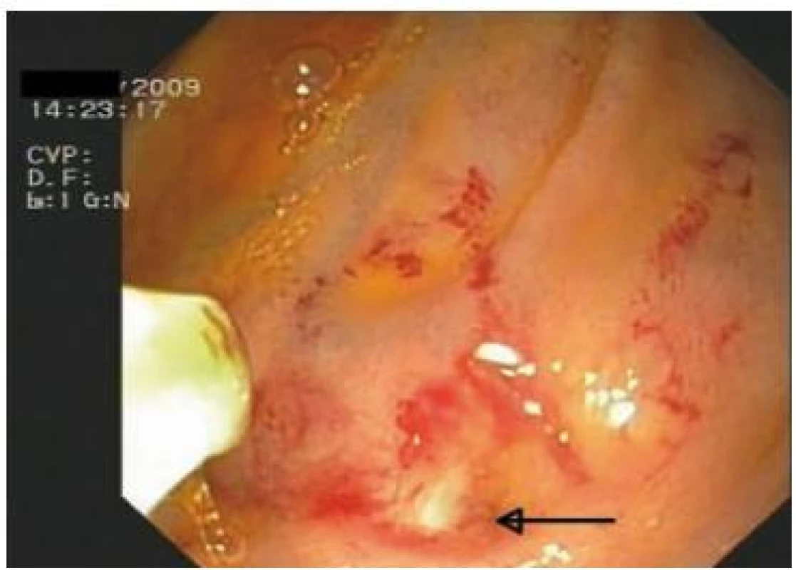 Endoskopický pohled na vyústění stenotizované HJA. Ústí je velmi gracilní, nelze jej nasondovat ani 5Fr kanylou. Označeno šipkou.
Fig. 4. Endoscopic view of an opening of stenotic HJA. The opening is very claval and cannot be probed into, not even using a 5-Fr cannula. This is designated by an arrow.