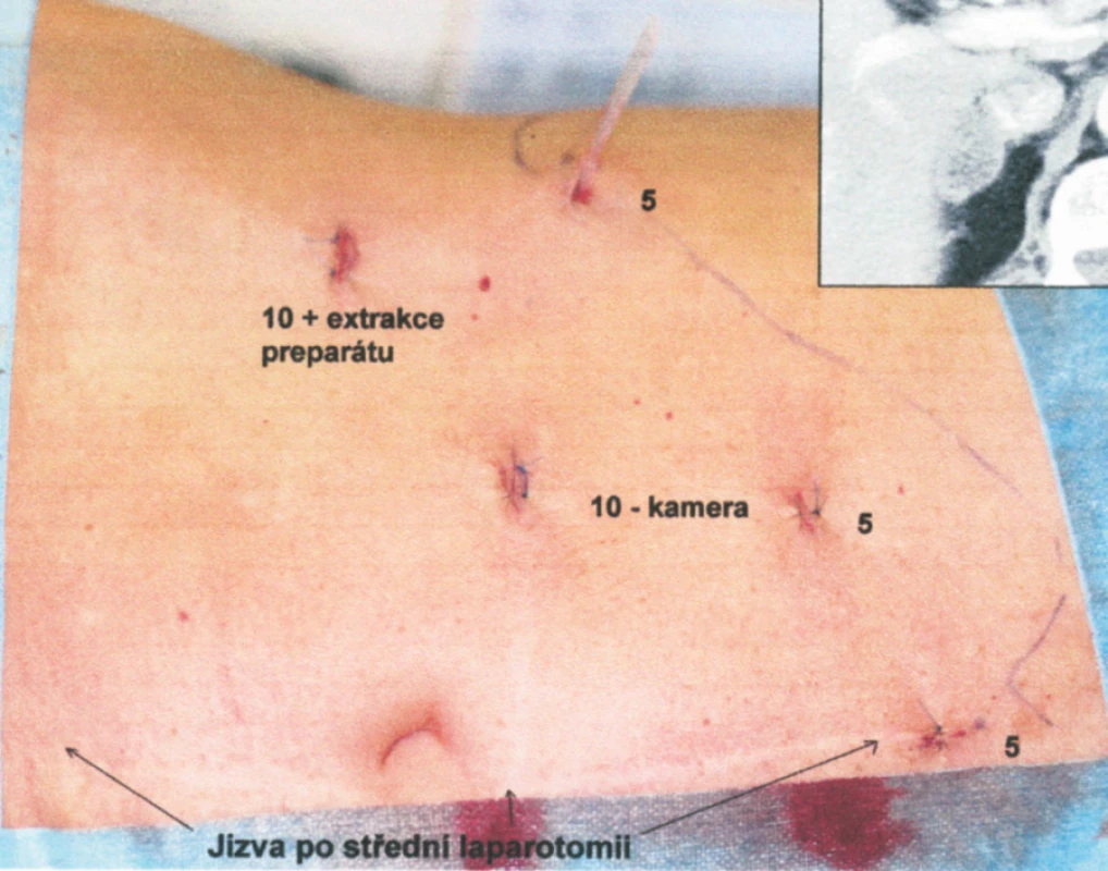 Pacientka po hysterektomii Pfannestielovým řezem, apendektomii ze střídavého řezu a aortobifemorálním bypassu ze střední laparotomie. Provedena LA vpravo pro kortikální adenom 32 mm (viz CT v pravém rohu) s incipientně vznikajícím multifokálním myelolipomem. Přístup z 5 portů
Fig. 2. A female patient, st. p. hysterectomy via a Pfannestiel incision, appendectomy via a McBurney-Sprengel muscle-splitting incision and aortobifemoral bypass via a midline incision. The procedure included laparoscopic adrenalectomy on the right for cortical adenoma of 32 mm (see in the right corner of the CT view) with incipient multifocal myelolipoma. Approach via 5 ports