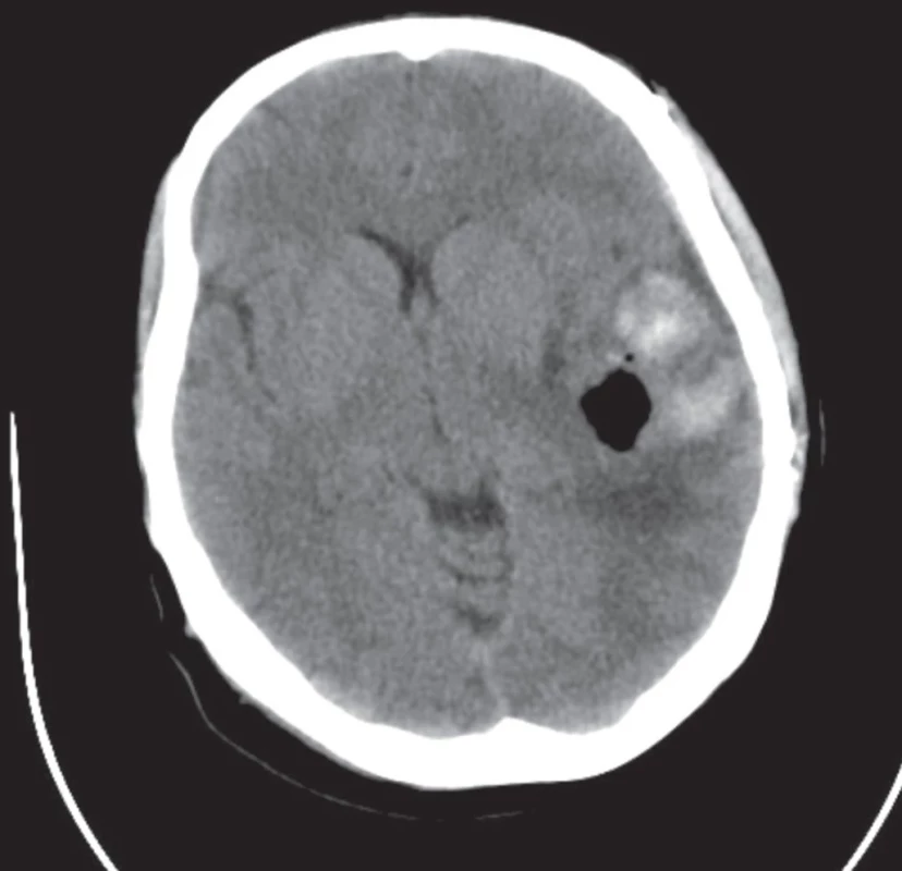 CT mozgu. </br>Fig. 2. CT of the brain.