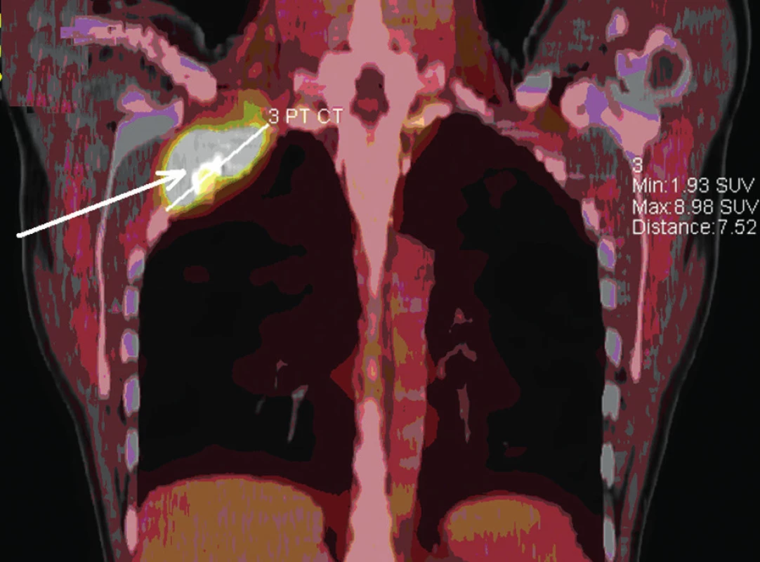 PET CT, kazuistika 2
Fig. 2: PET CT scan, case report 2
