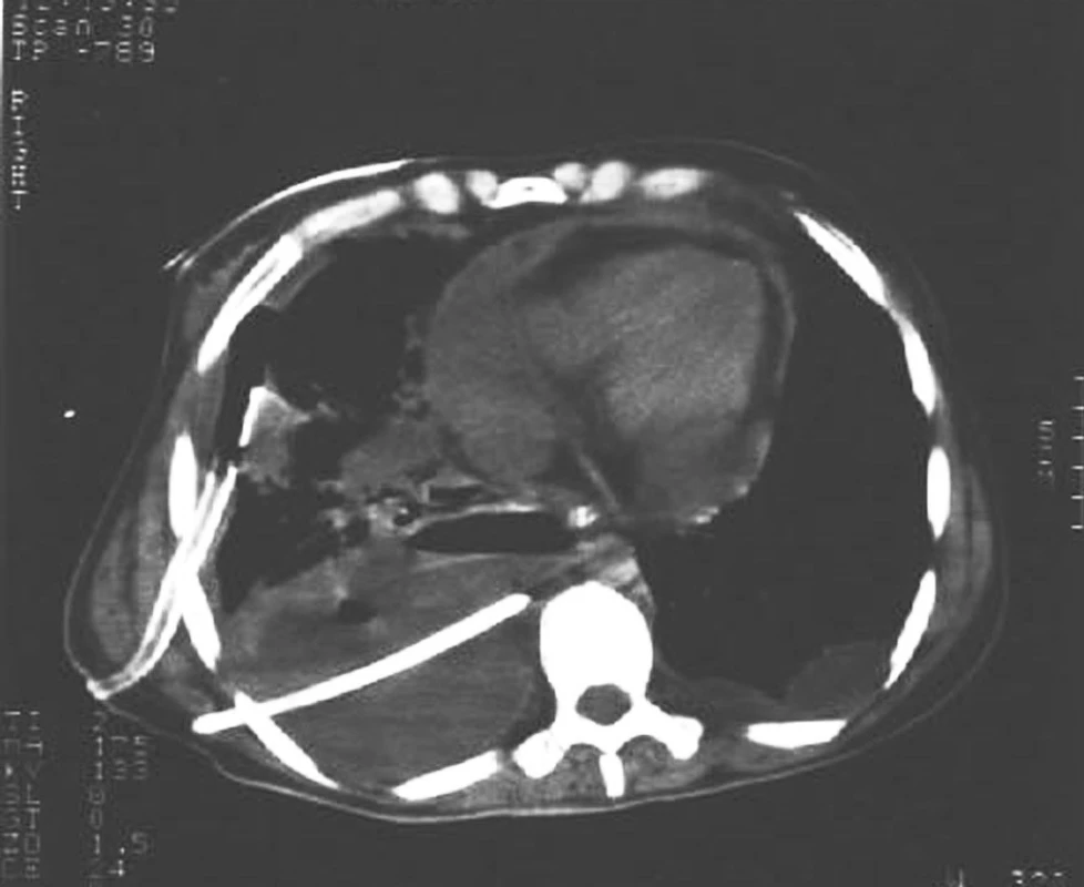 CT snímek hrudníku s drénovaným výpotkem
Fig. 1. A CT scan of a thorax with drained exudate